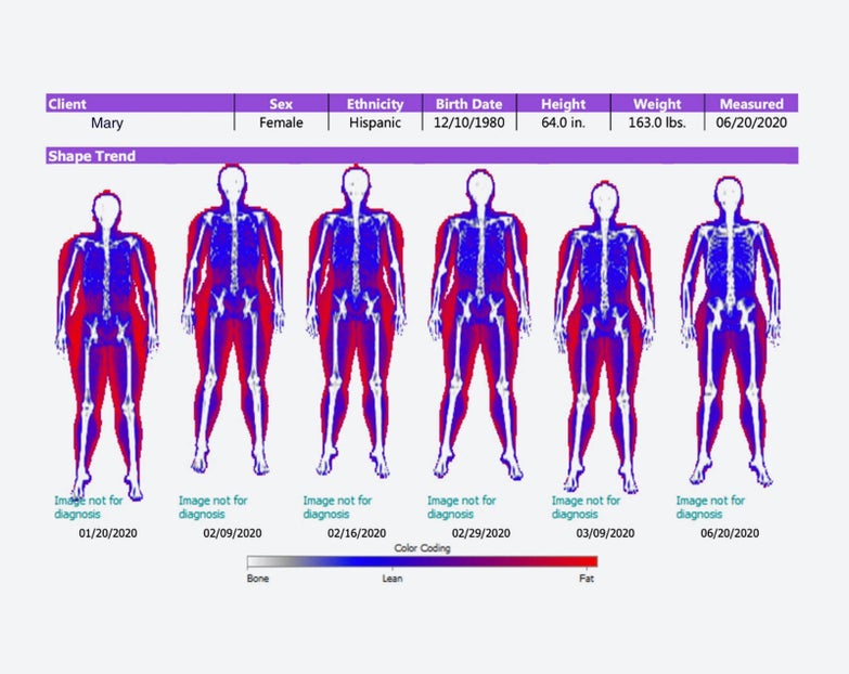 Escaneo DEXA de Mary